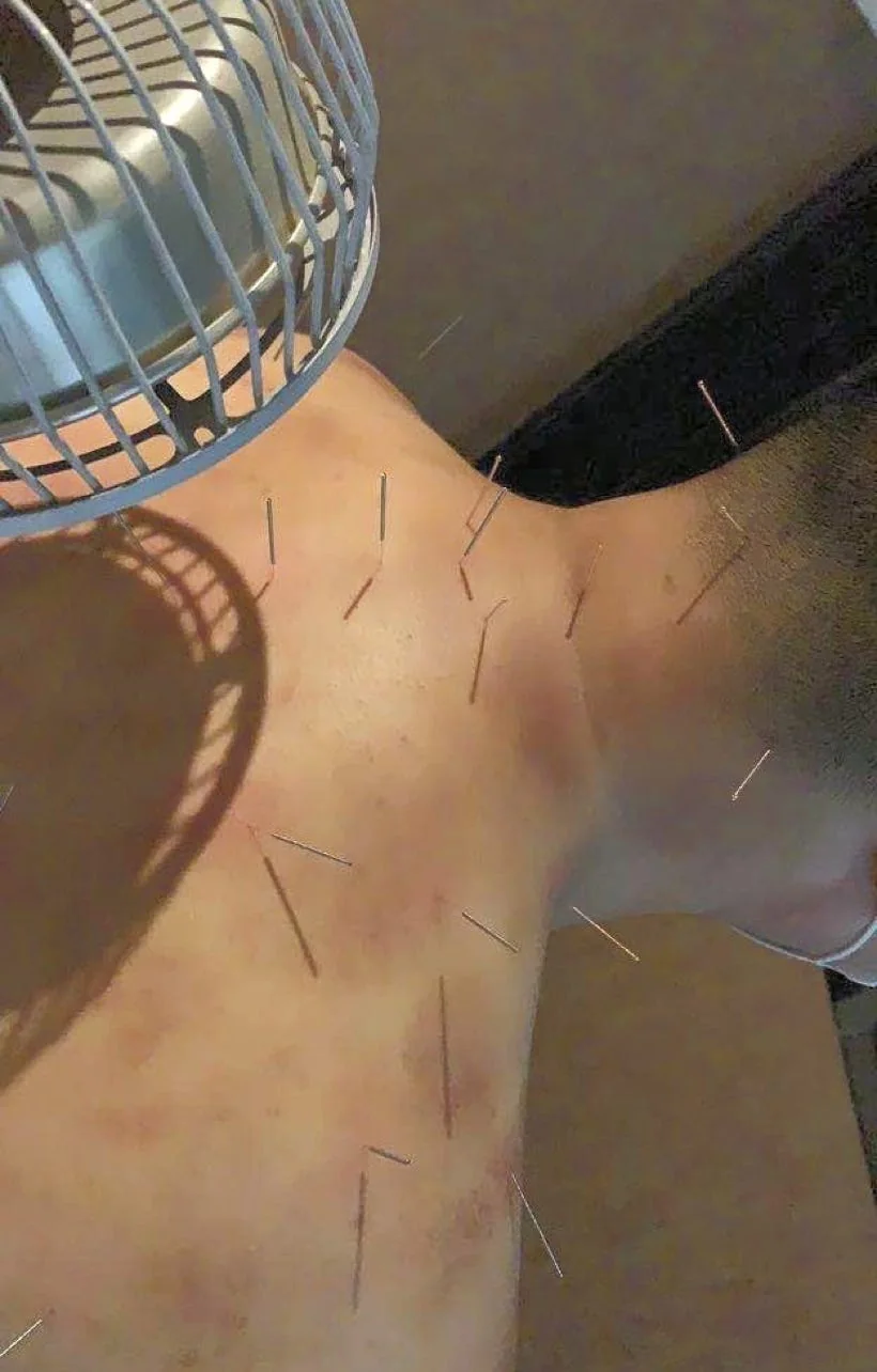Acupuncture needles used during a clinic session
